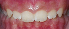 SureSmile Before and After Pictures Atlanta, GA