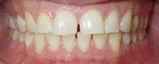 SureSmile Before and After Pictures Atlanta, GA