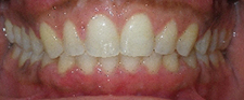 SureSmile Before and After Pictures Atlanta, GA