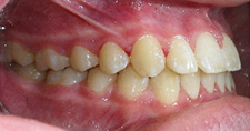 SureSmile Before and After Pictures Atlanta, GA