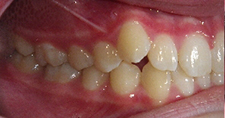 SureSmile Before and After Pictures Atlanta, GA