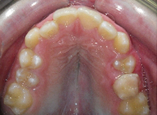 SureSmile Before and After Pictures Atlanta, GA