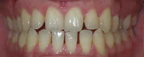 SureSmile Before and After Pictures Atlanta, GA