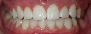 SureSmile Before and After Pictures Atlanta, GA