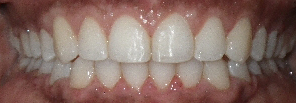 SureSmile Before and After Pictures Atlanta, GA