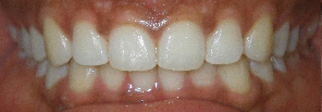 SureSmile Before and After Pictures Atlanta, GA