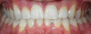 SureSmile Before and After Pictures Atlanta, GA