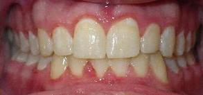 SureSmile Before and After Pictures Atlanta, GA