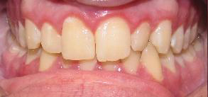 SureSmile Before and After Pictures Atlanta, GA