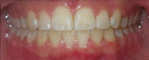 SureSmile Before and After Pictures Atlanta, GA