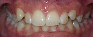 SureSmile Before and After Pictures Atlanta, GA