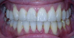 SureSmile Before and After Pictures Atlanta, GA