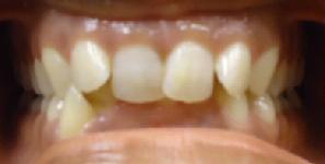 SureSmile Before and After Pictures Atlanta, GA