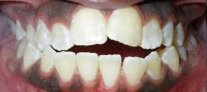 SureSmile Before and After Pictures Atlanta, GA