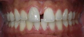 SureSmile Before and After Pictures Atlanta, GA