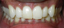 SureSmile Before and After Pictures Atlanta, GA