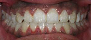 SureSmile Before and After Pictures Atlanta, GA