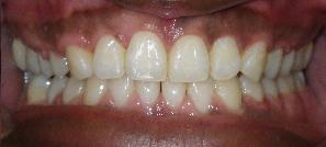 SureSmile Before and After Pictures Atlanta, GA