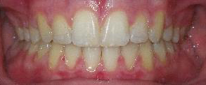 SureSmile Before and After Pictures Atlanta, GA