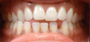 SureSmile Before and After Pictures Atlanta, GA