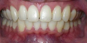 SureSmile Before and After Pictures Atlanta, GA