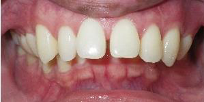 SureSmile Before and After Pictures Atlanta, GA