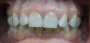 SureSmile Before and After Pictures Atlanta, GA