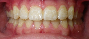 SureSmile Before and After Pictures Atlanta, GA