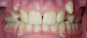 SureSmile Before and After Pictures Atlanta, GA