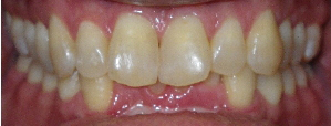 SureSmile Before and After Pictures Atlanta, GA