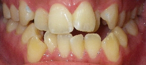 SureSmile Before and After Pictures Atlanta, GA