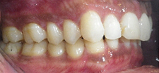 SureSmile Before and After Pictures Atlanta, GA