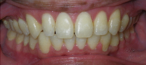 SureSmile Before and After Pictures Atlanta, GA