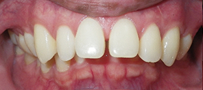 SureSmile Before and After Pictures Atlanta, GA