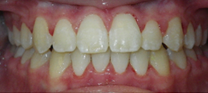 SureSmile Before and After Pictures Atlanta, GA