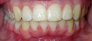 SureSmile Before and After Pictures Atlanta, GA