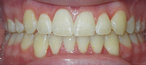 SureSmile Before and After Pictures Atlanta, GA