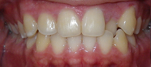 SureSmile Before and After Pictures Atlanta, GA