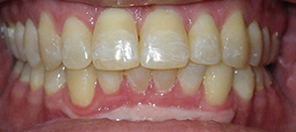 SureSmile Before and After Pictures Atlanta, GA