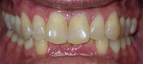 SureSmile Before and After Pictures Atlanta, GA