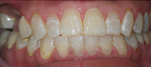 SureSmile Before and After Pictures Atlanta, GA