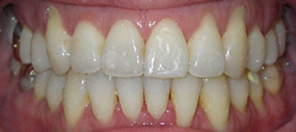 SureSmile Before and After Pictures Atlanta, GA