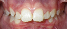 SureSmile Before and After Pictures Atlanta, GA