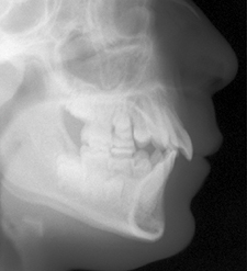 SureSmile Before and After Pictures Atlanta, GA