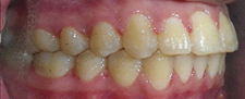 SureSmile Before and After Pictures Atlanta, GA